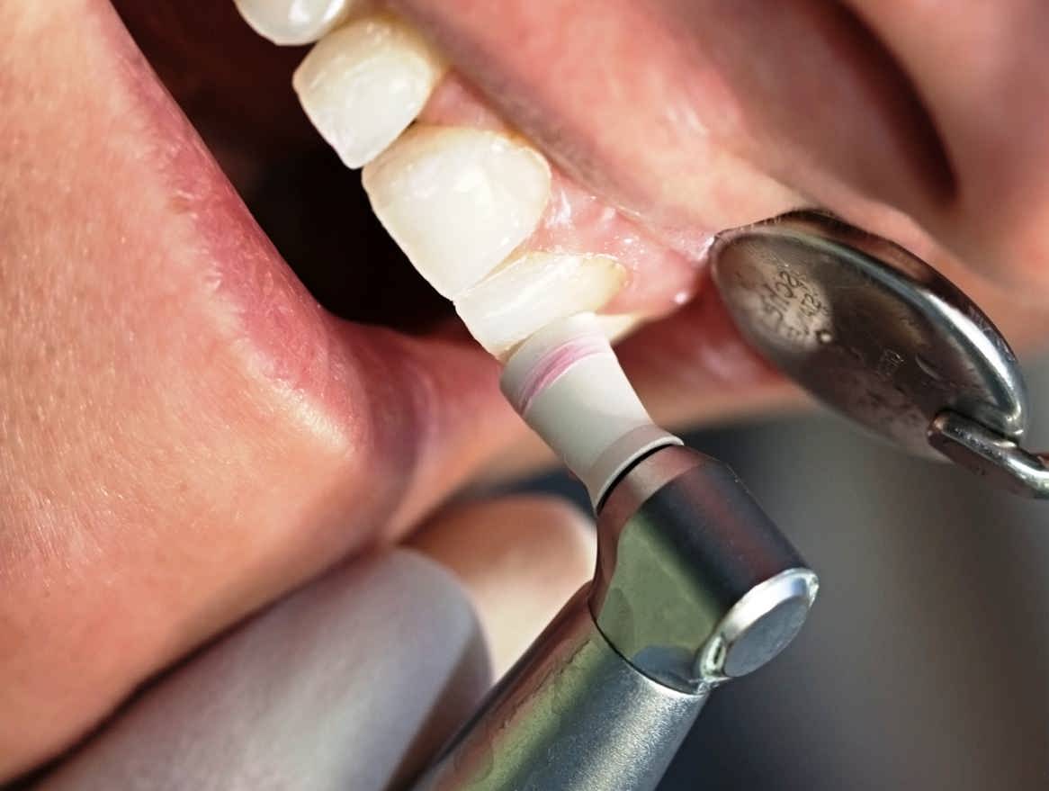 5 مارک انواع لمینت دندان ثابت و متحرک را بهتر بشناسید